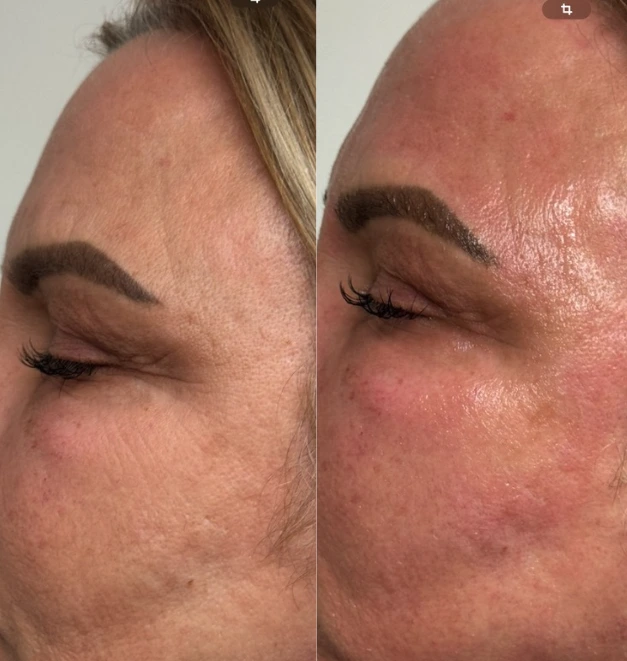 Vorher-Nachher Ergebnisse der Laser-Haarentfernung bei Laser Angel Hamburg