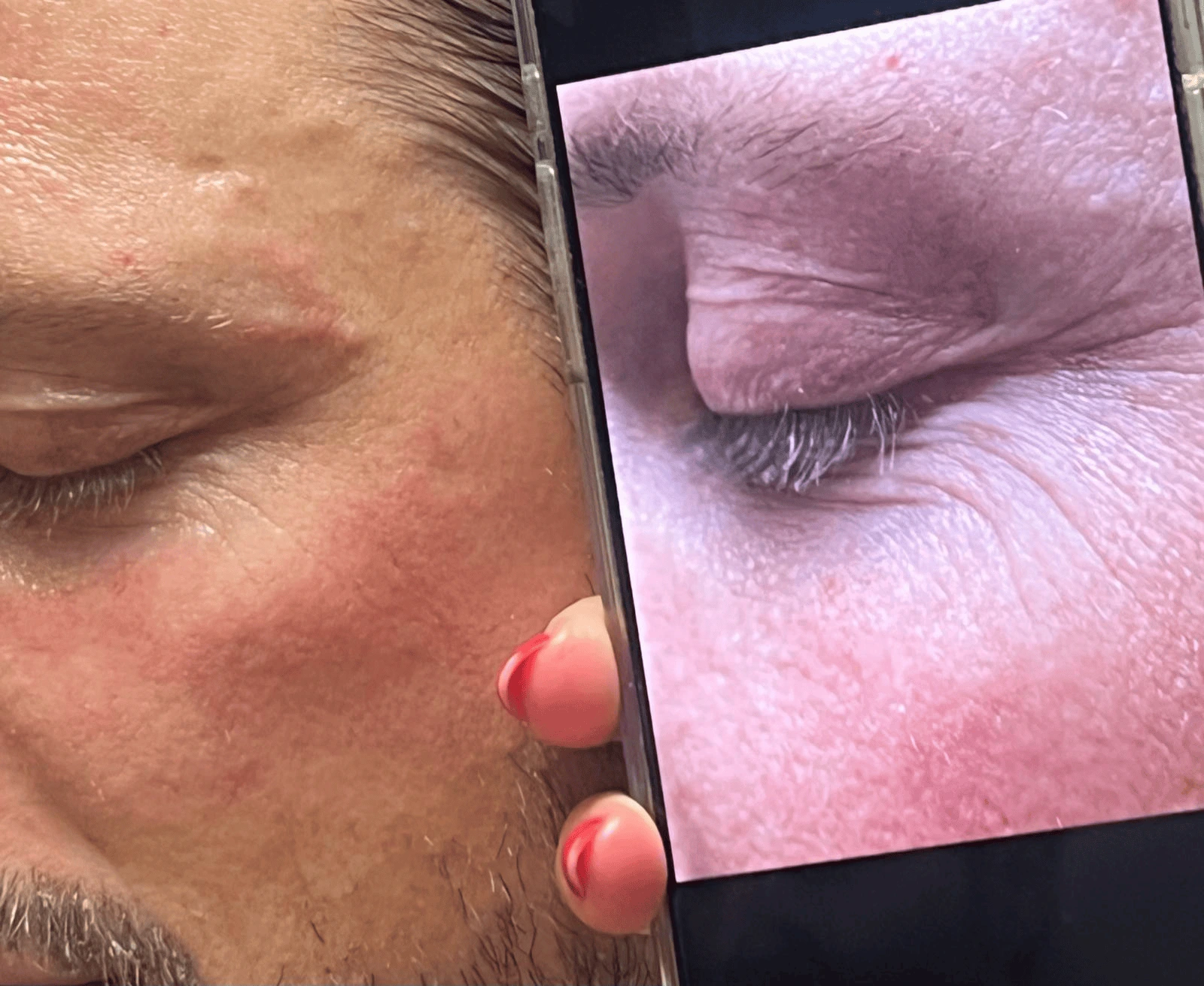 Vorher-Nachher Ergebnisse der Laser-Haarentfernung bei Laser Angel Hamburg